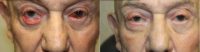 65-74 year old man treated with Eyelid Retraction Repair