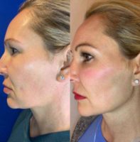 45-54 year old woman treated with Injectable Fillers for Jawline