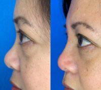 45-54 year old woman treated with Nonsurgical Nose Job