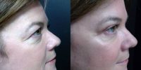 45-54 year old woman treated with Eyelid Surgery