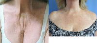 55-64 year old woman treated with Wrinkle Treatment