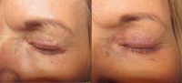 55-64 year old woman treated upper eyelid scars with fractional ablative resurfacing
