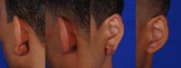 18-24 year old man treated with Ear Surgery