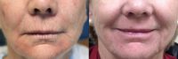 55-64 year old woman treated with Injectable Fillers