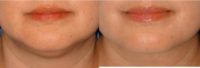 50 year old woman treated with 3 total vials of Kybella