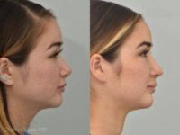 Woman treated with Septoplasty