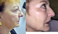 65-74 year old woman treated with Dermapen