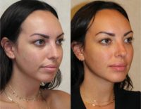 25-34 year old woman treated with Toxin for Chin Enhancement and Augmentation