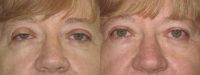 45-54 year old woman treated with Ptosis Surgery