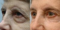 65-74 year old woman treated with Forehead Lift