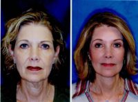 Face Lift, Coapt Cheek Lift, Neck Lift Upper and Lower Bleph and Brow Lift