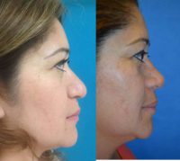 Primary Rhinoplasty Before & After Photos
