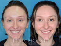 25-34 year old woman treated with Botox for Gummy Smile