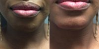 35-44 year old woman treated with Radiess for chin augmentation