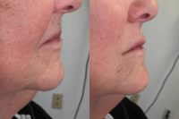 65-74 year old woman treated with Lip Augmentation