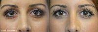 Under eye bags treatment - Tear trough filler - Belotero