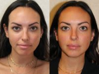 25-34 year old woman treated with toxin only for Nonsurgical Chin Enhancement and Augmentation