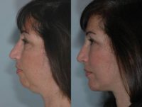 Fat Injections, Chin Implant, Submental Liposuction, Facelift, Lower Lid 88% Phenol Peel