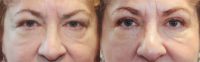 58 year old woman treated with Ptosis Surgery