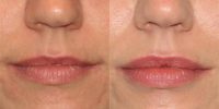 25-34 year old woman treated with Restylane
