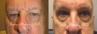Upper Blepharoplasty and Brow Lift