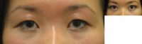 Double eyelid surgery with CO2 laser