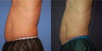 45-54 year old man treated with SculpSure