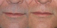 55-64 year old man treated with subnasal lip lift