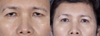 68 year old Asian female with excessive eyelid skin and brow ptosis