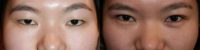 18-24 year old woman treated with Double Eyelid Surgery