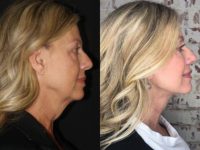 45-54 year old woman treated with Facelift and Neck Lift