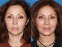 Facial Rejuvenation with SMAS Facelift