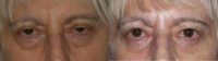 65-74 year old woman treated with Eye Bags Treatment