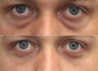 Lower eyelid surgery from behind eyelid (transconjunctival)