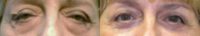 Upper eyelids blepharoplasty (excess skin removal) with ptosis muscle tightening
