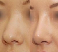 Rhinoplasty with augmentation of the bridge and tip refinement