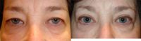 45-54 year old woman treated with Upper Eyelid Surgery