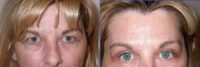 Endoscopic Brow Lift and Bilateral Upper Blepharoplasty