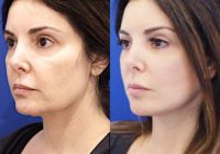 45-54 year old woman treated with Deep Plane Facelift