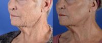 65-74 year old woman treated with CO2 Laser