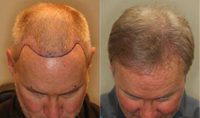 Man treated with NeoGraft