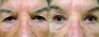75 and up year old woman treated with Brow Lift
