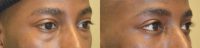 Young African American male underwent Scarless Lower Blepharoplasty