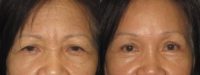 65-74 year old woman treated with Brow Lift
