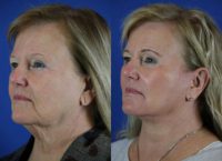 67 year old woman treated with Facelift