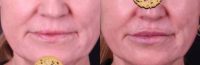 55-64 year old woman treated with Restylane Refyne
