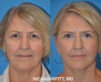 45-54 year old woman treated with Lower Facelift