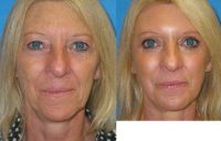 55-64 year old woman treated for Eyelid Surgery
