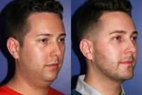 32 year old man treated with Chin Surgery