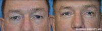 45-54 year old man treated with Eyelid Surgery - Upper & Lower Blepharoplasty